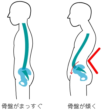 骨盤の前の傾き