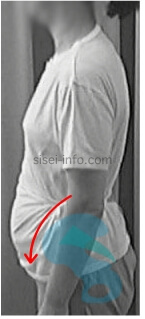 反り腰と下腹部の実例